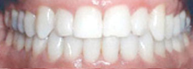 After-Before & After Invisalign Treatment