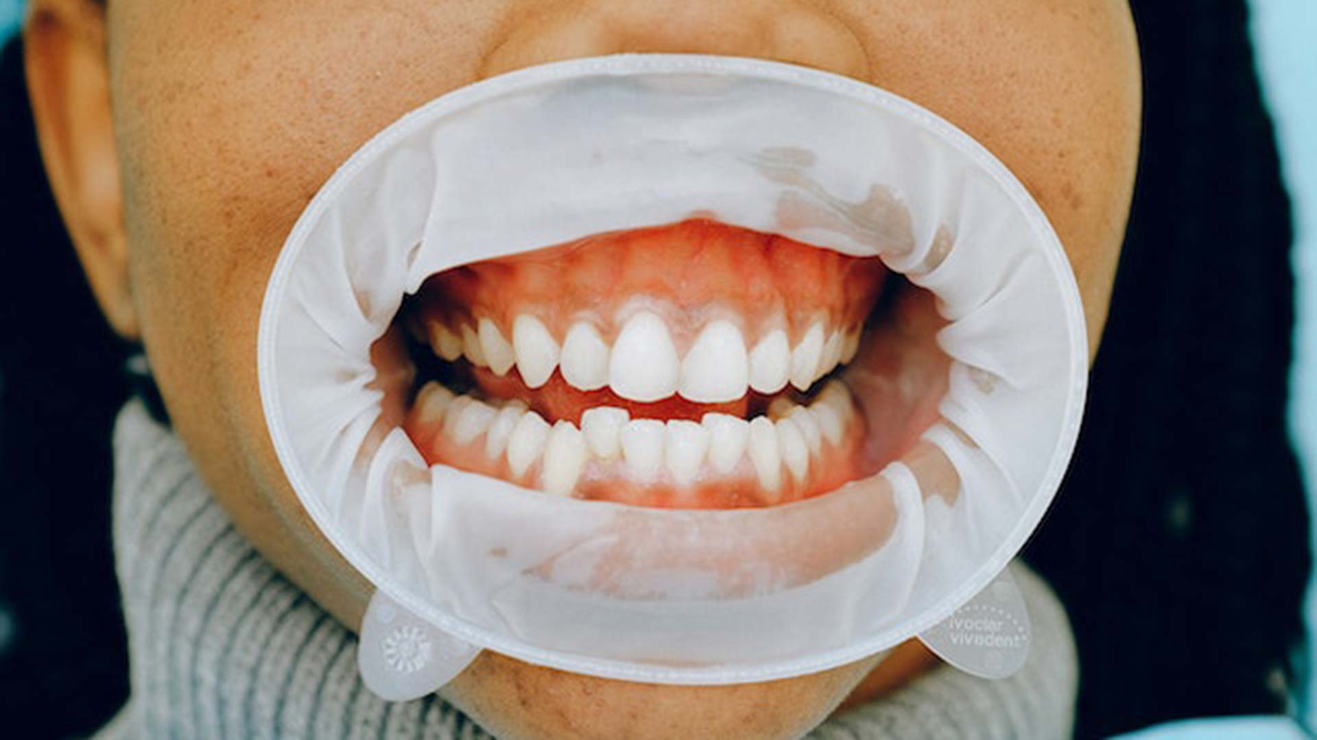 Is It Time to Bid Farewell to Flossing? A Comprehensive Guide to Healthy Gums