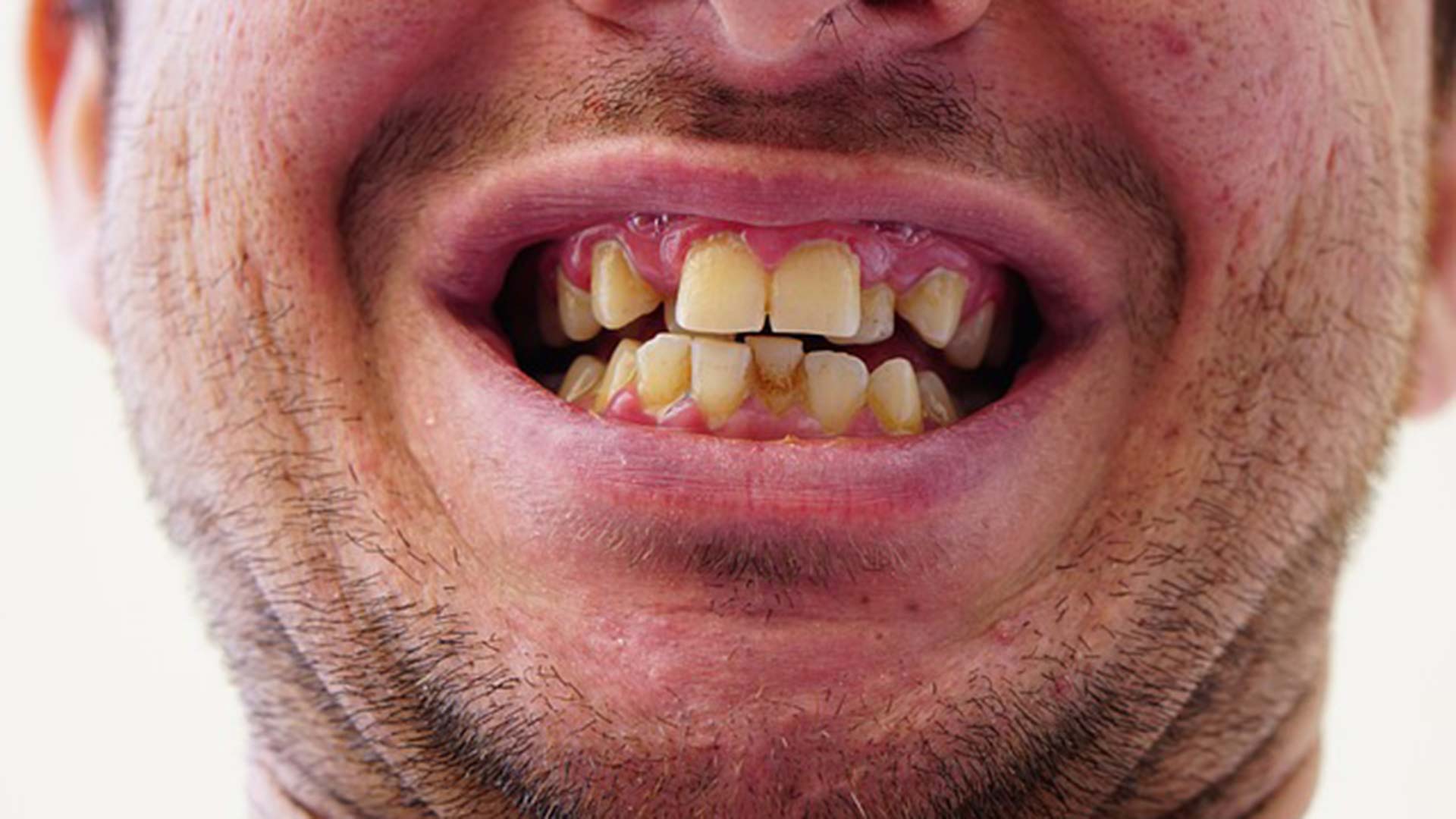 My Teeth are Wonky: What are my Options? 